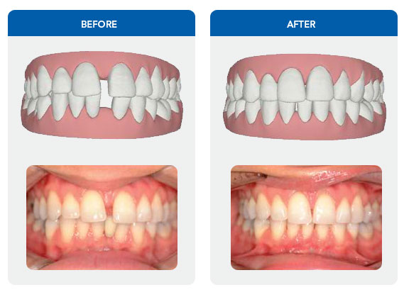 Invisalign Invisible Braces Before & After Photos