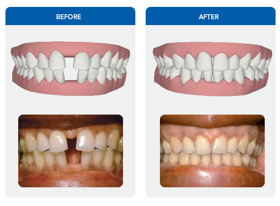 Invisible Orthodontics - Implantcenter dentistry UK