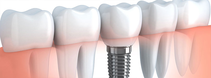 Invisible Orthodontics - Implantcenter dentistry UK